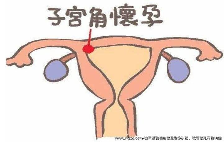日本试管费用要准备多少钱，代孕花费明细